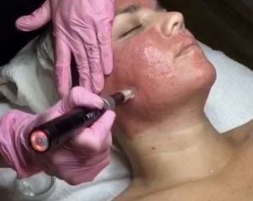 Dermaplaning … Will my hair grow back thicker? Dermaplaning … Will my hair grow back thicker?